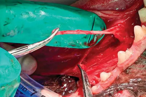 Radiation therapy for a recurrent sialocele