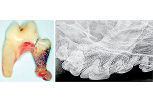 Have you heard of the chevron lucency?