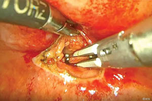 Minimally invasive surgery techniques improve idiopathic chylothorax treatments