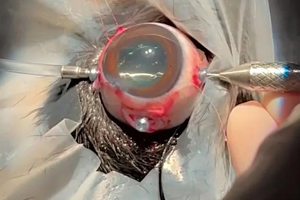 Spotlight on vitreoretinal surgery